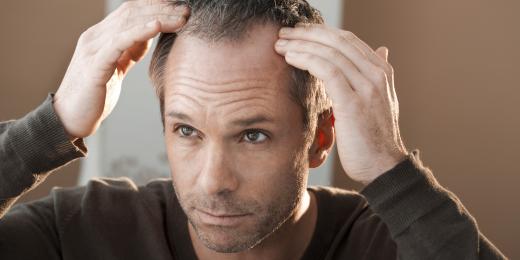 Alopecie neboli ztráta vlasů u žen a mužů