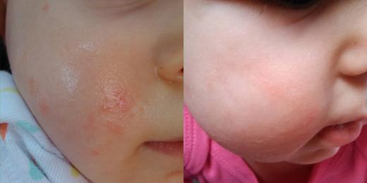 Jak na seboreickou dermatitidu u dětí?
